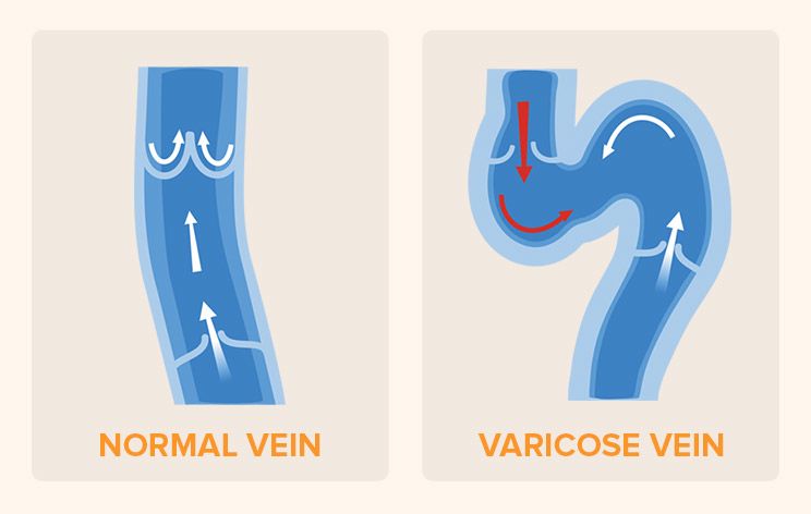 varicose veins vs normal veins