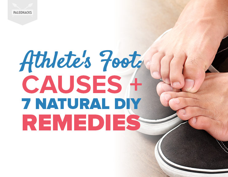 Athlete's Foot: Causes + 7 Natural DIY Remedies 1